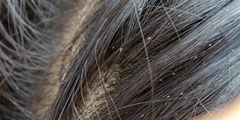 Kutu Rambut - Gejala, Penyebab & Cara Mengatasinya