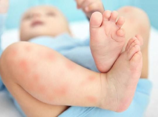 10 Penyakit Kulit Pada Bayi yang Sering Muncul dan Cara Mengatasinya